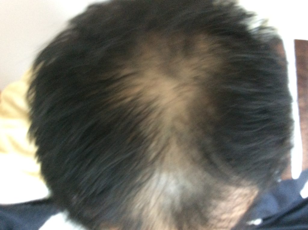 髪の毛を太くしたい方必見 髪の毛を太くする方法と種類 ローソン薄毛抜毛aga治療対策改善支援研究レポート