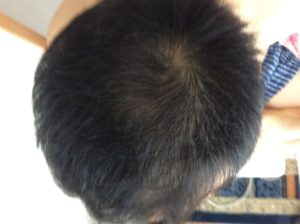 運動と AGA 治療 薬を併用した ことによる 薄毛 改善 写真 途中経過