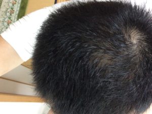 運動と AGA 治療薬 による 薄毛 改善 写真