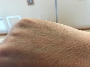 プロペシア,ミノキシジル,効果写真