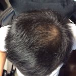 管理人　2020年7月までミノキシジルのみ薄毛抜け毛 M 字抜け毛治療効果画像写真