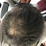 管理人　2021年1月～　ダーマローラー、ミノキシジル、フィナステリド（フィンペシア）薄毛抜け毛 M 字抜け毛治療効果画像写真