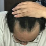 「自毛植毛の効果と成功率とは？M字・生え際植毛体験談とビフォーアフターで見るクリニックの実績」CA2