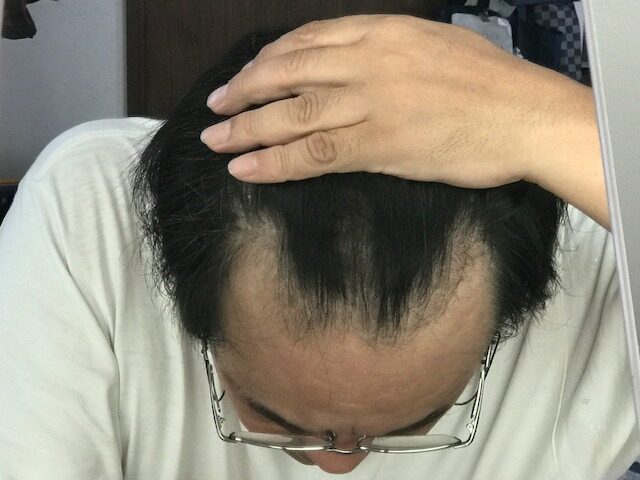 自毛植毛を行わなかったために逆に悲惨なハゲＭ字