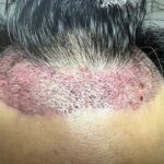 自毛植毛で悲惨で後悔のない人生を歩む