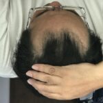 ミノキシジル プロペシア「AGA治療の方法とおすすめ薬｜効果が期待できる治療薬と育毛剤を徹底解説」